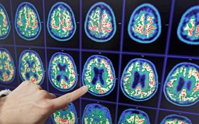 Le diagnostic complet de la maladie d’Alzheimer