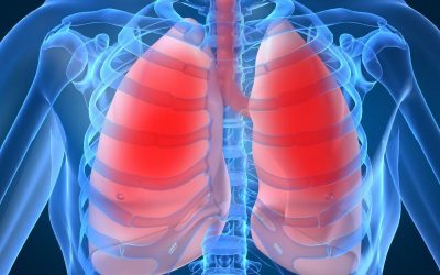 Infections pulmonaires (pneumonies) : remèdes naturels