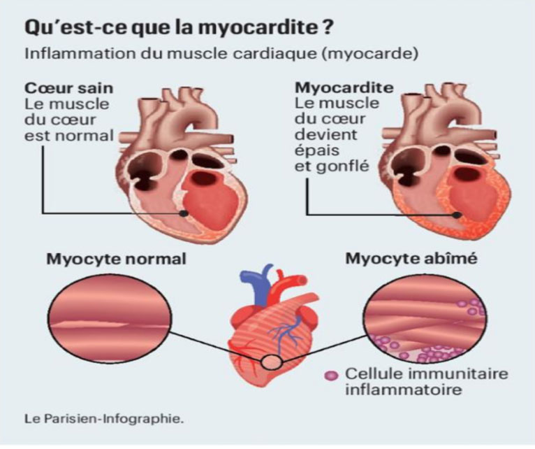 myocardite