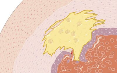 Athérosclérose : causes, symptômes, traitements naturels